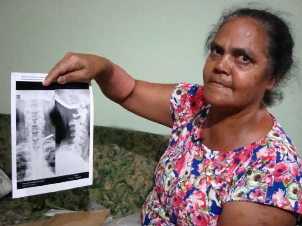 Mulher descobre que viveu com pedaço de faca no ombro por 37 anos