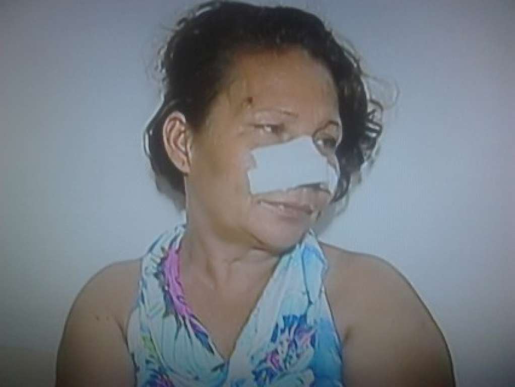 Mulher tem parte de nariz arrancado com mordida em Camacan
