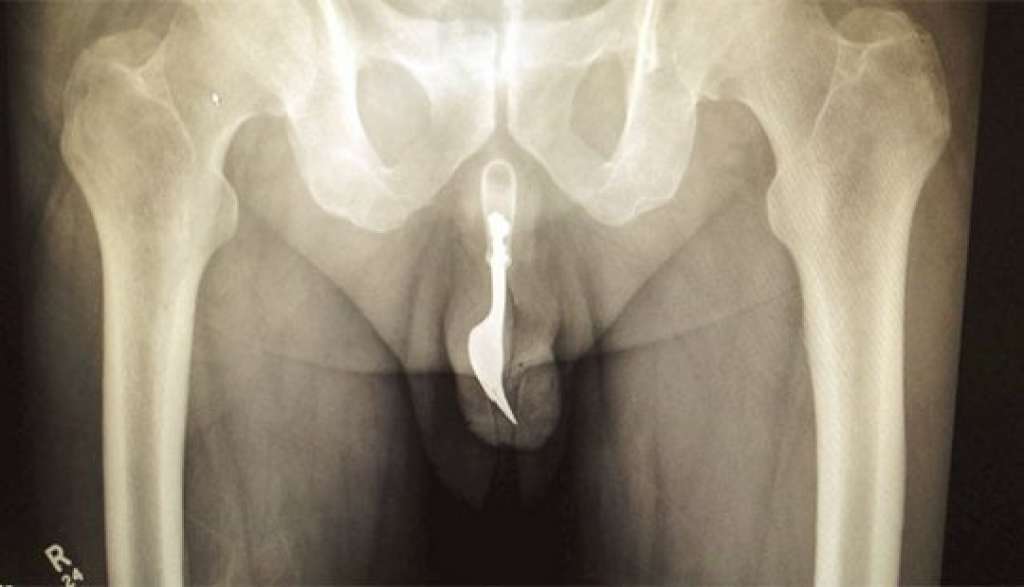 Idoso passa por cirurgia após introduzir garfo no pênis em ato sexual