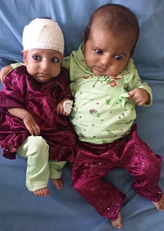 Após retirar ‘2ª cabeça’, menina afegã é vista ao lado da irmã gêmea