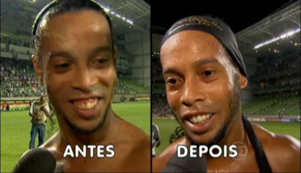 “Olhar no espelho e se sentir bem”, diz Ronaldinho sobre novo sorriso