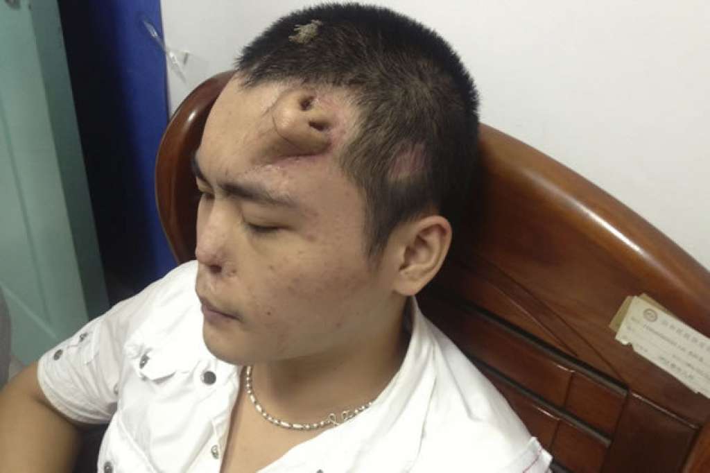 Médicos criam nariz artificial na testa de paciente na China