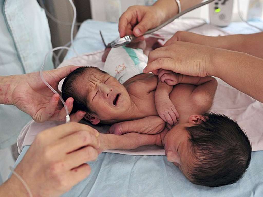 Siameses recém-nascidos na China fazem consulta para avaliar quadro