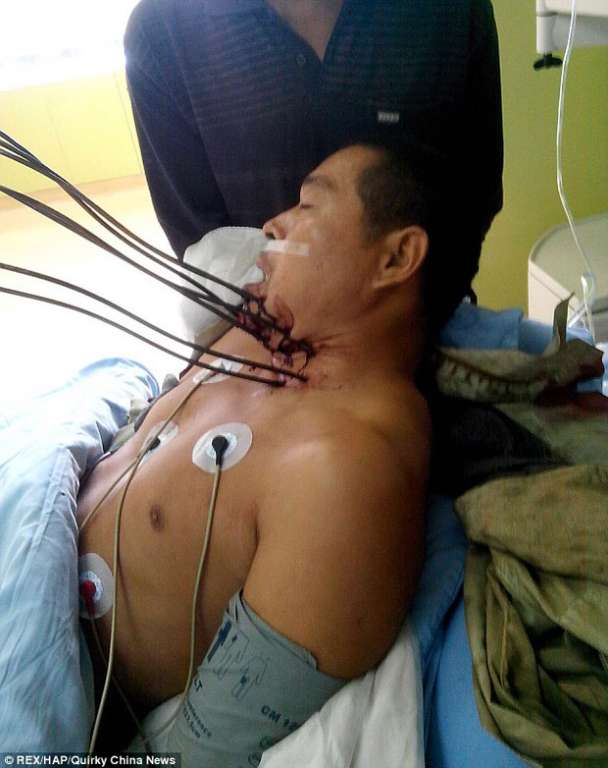 Homem sobrevive após perfurar pescoço com sete barras de metal