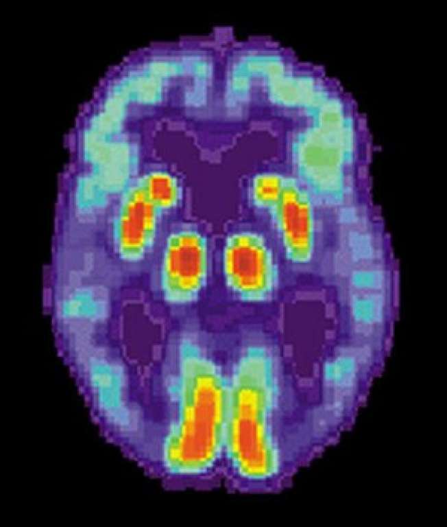 Nova descoberta pode levar à cura de Alzheimer
