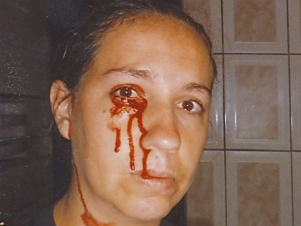 Mulher que ‘chora sangue’ intriga oftalmologistas