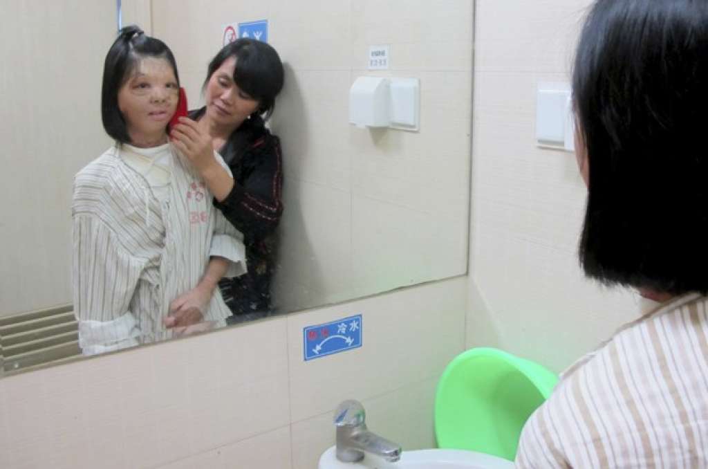 Cirurgia de reconstituição de face em chinesa é bem sucedida; veja foto