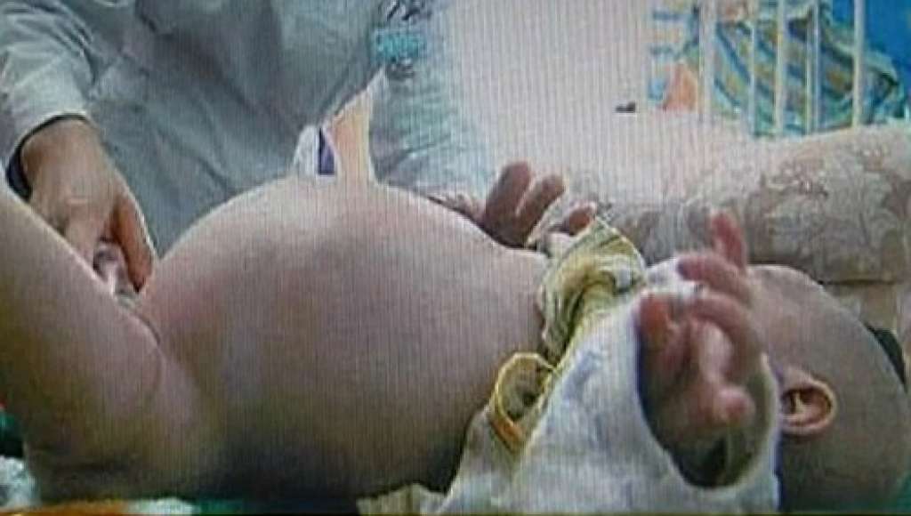Menino de dois anos grávido passa por cirurgia para retirar feto