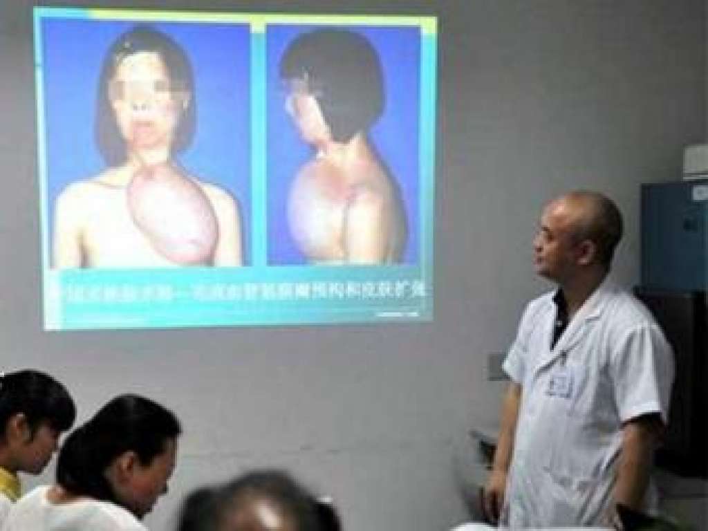 Chinesa tem rosto cultivado no peito e fará transplante