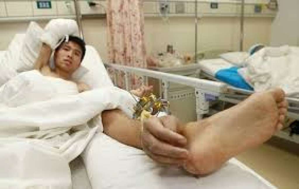 Homem tem mão reimplantada após membro ficar 1 mês ligado a tornozelo