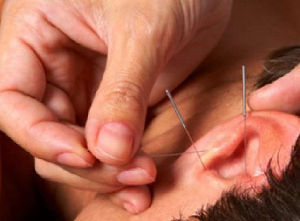 Segundo pesquisa, Acupuntura em cinco pontos da orelha ajuda a emagrecer