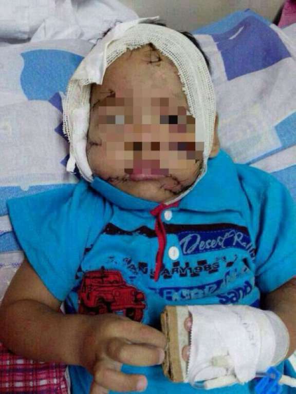 Criança de 1 ano fica com o rosto desfigurado após ser atacada por um pitbull