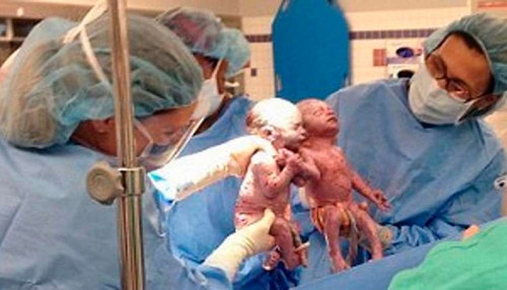 Gêmeas nascem de mãos dadas no Dia das Mães