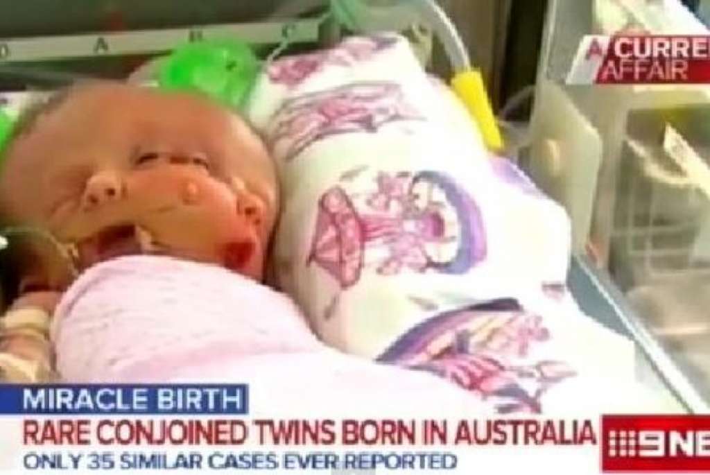 Gêmeas siamesas nascem com um único corpo e dois cérebros