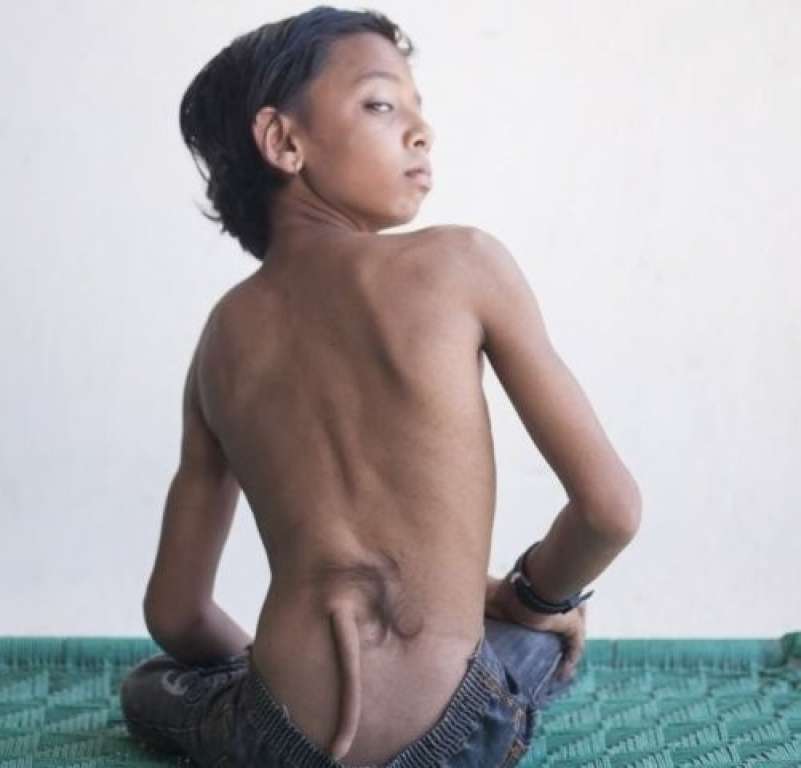 Garoto de 13 anos é considerado reencarnação de deus por ter ‘cauda’ nas costas