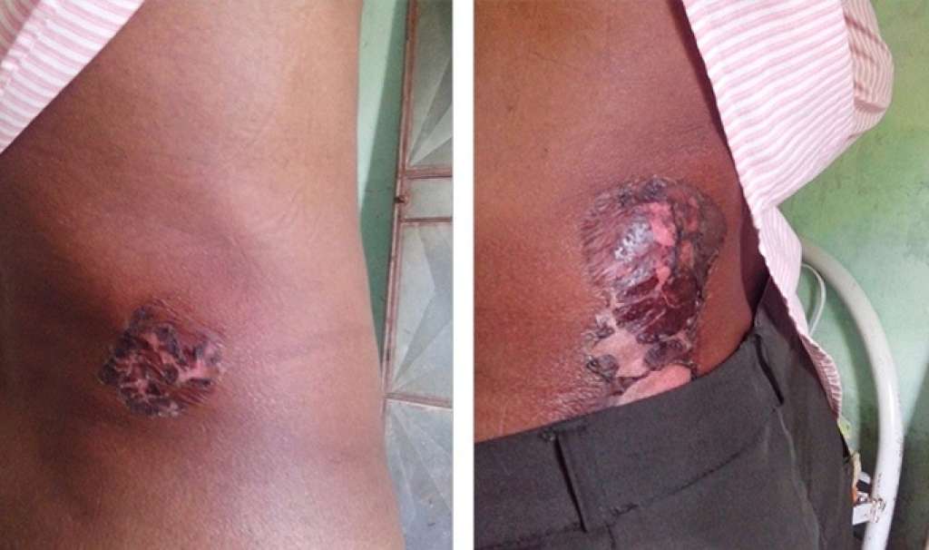 Paciente sofre queimaduras durante cirurgia em hospital de Dias D’Ávila
