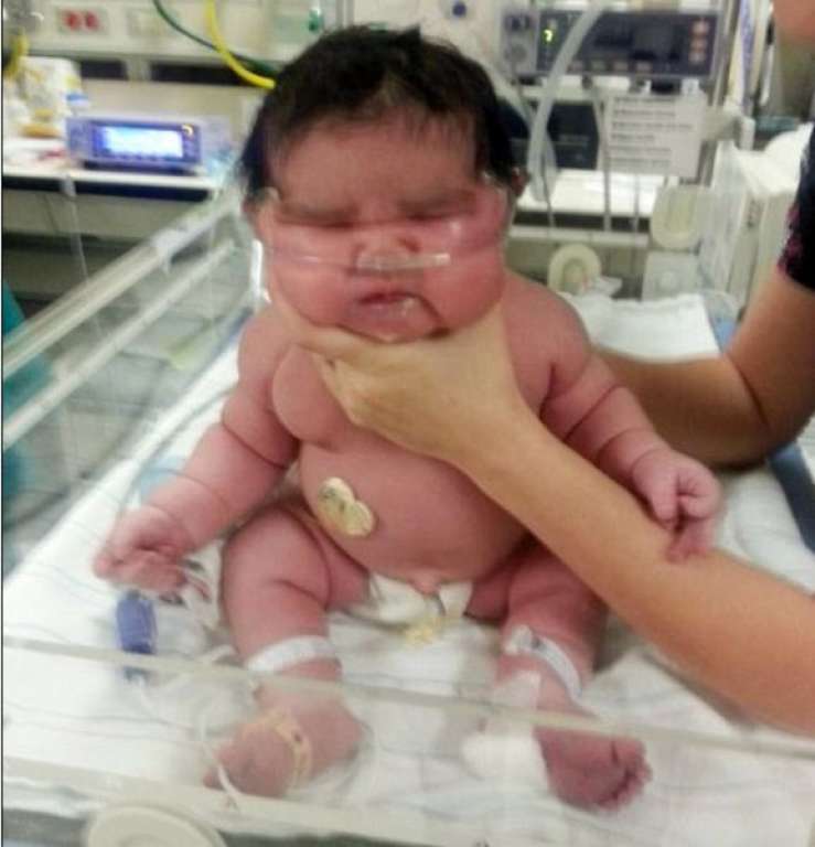 Bebê nasce pesando mais de 6 quilos e assusta equipe médica