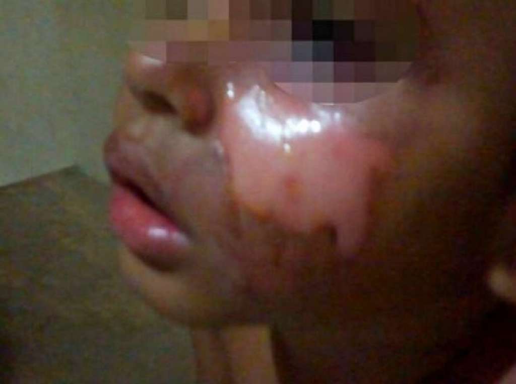 Após brigar com marido, mulher queima rosto do filho de cinco anos