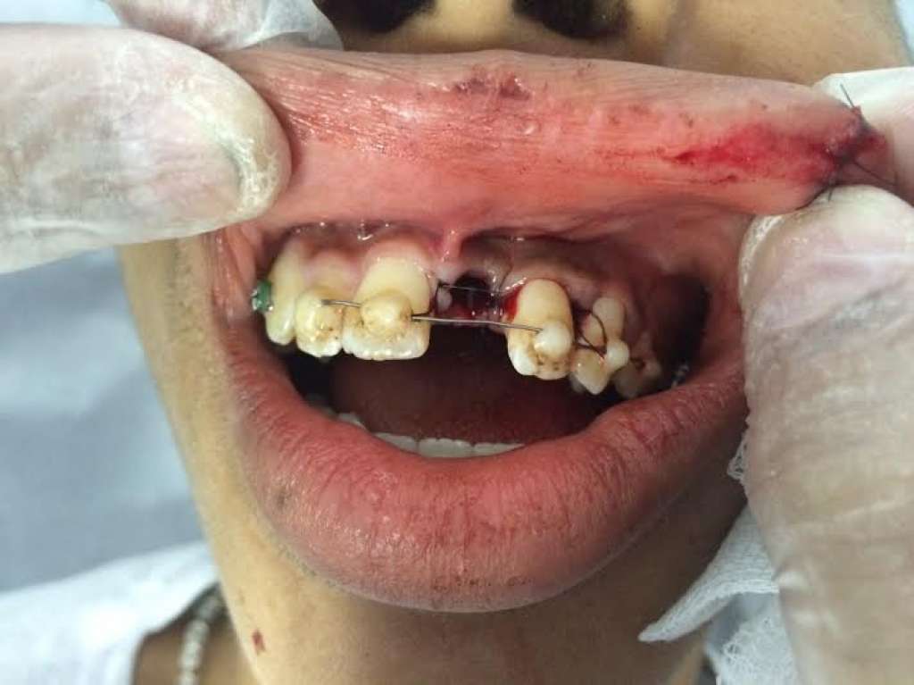 Vítimas de traumas faciais no Carnaval podem ter dentes restaurados