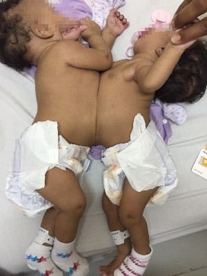 Gêmeas siamesas de Salvador são operadas em Goiânia