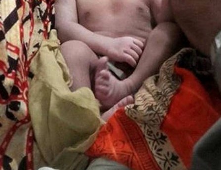 Criança nasce com duas cabeças em Bangladesh; veja foto