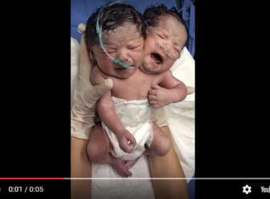 Vídeo mostra primeiros momentos de bebê de duas cabeças no México