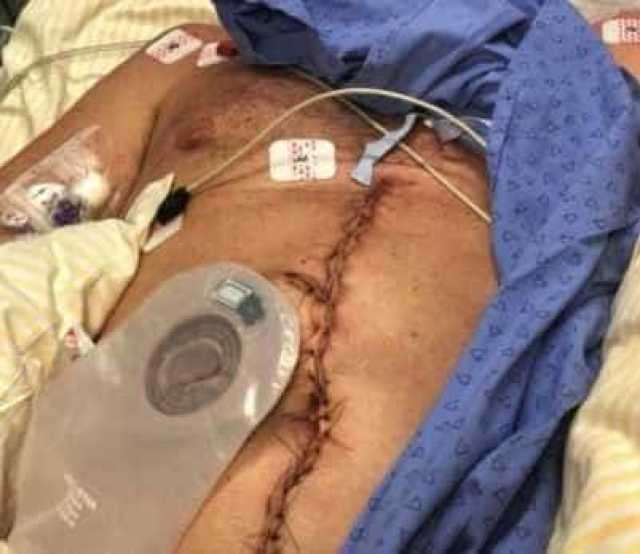 Magno Malta publica foto da cicatriz de Bolsonaro