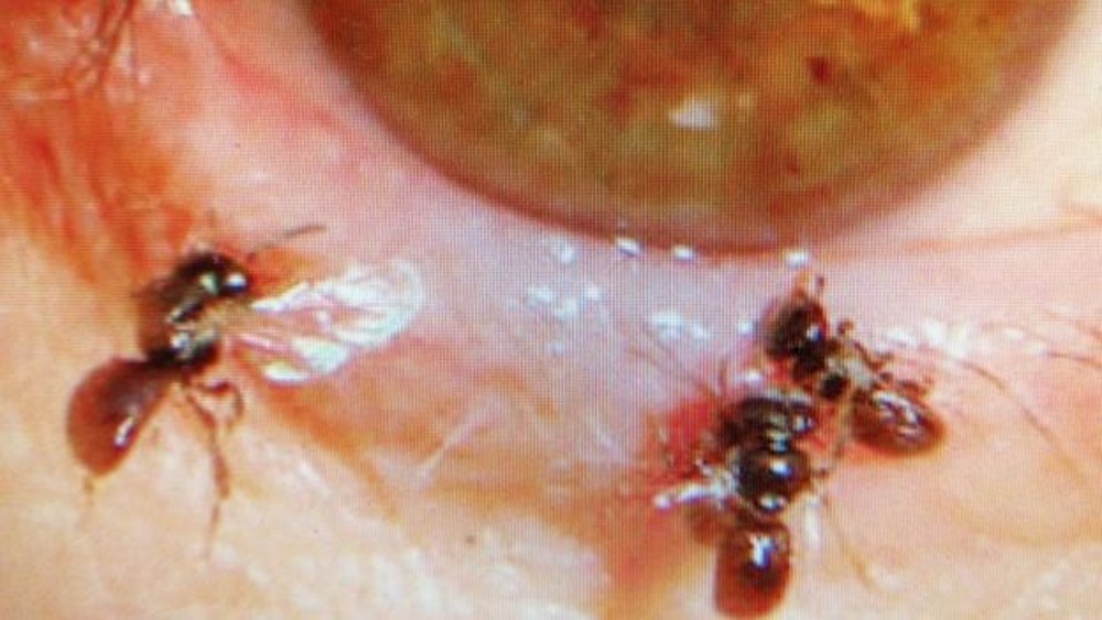Médico encontra quatro abelhas vivas dentro do olho de mulher