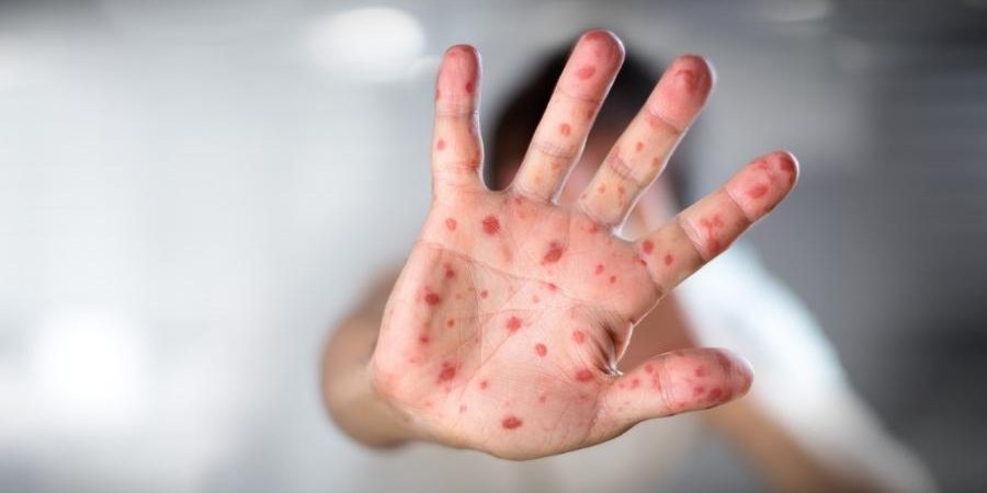 Casos de sarampo no país chegam a 2.753, diz Ministério da Saúde