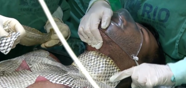 Pele de tilápia é utilizada como tratamento de queimaduras em hospital no RJ
