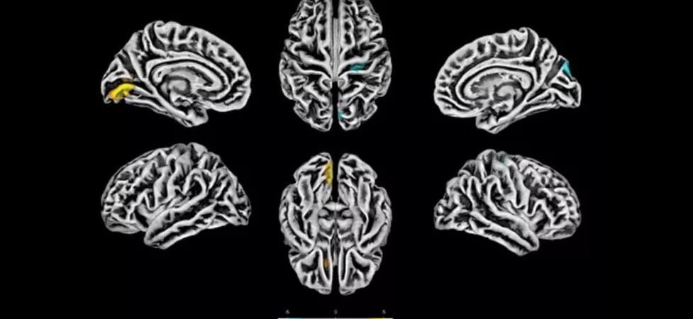 Estudo brasileiro aponta que Covid-19 afeta o cérebro e pode causar alterações mesmo em casos leves