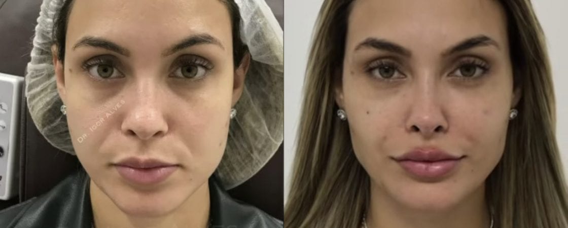 Ex-BBB Sarah Andrade faz harmonização facial; veja resultado
