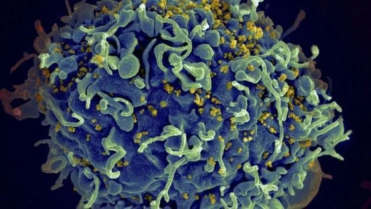 Primeira mulher é declarada curada do HIV após transplante de células-tronco