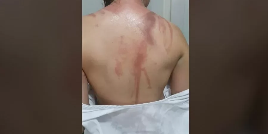 Trote em universidade deixa quase 20 calouros com queimaduras pelo corpo