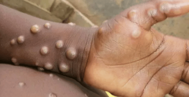 OMS declara emergência internacional de saúde para varíola dos macacos