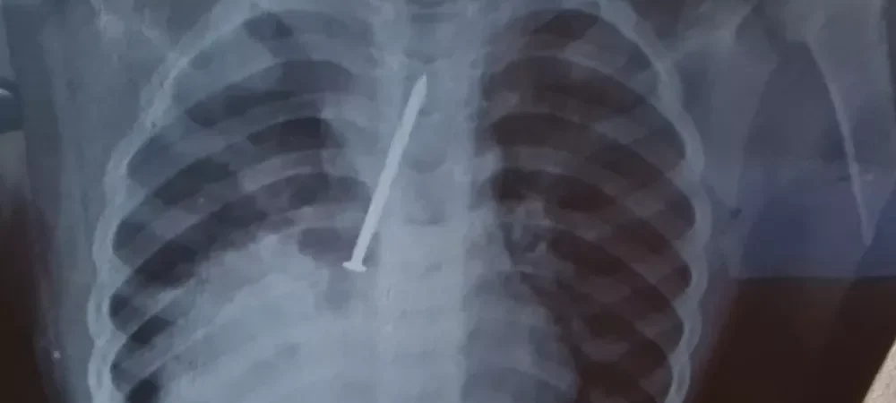 BA: Criança morre após passar 1 ano com prego no pulmão