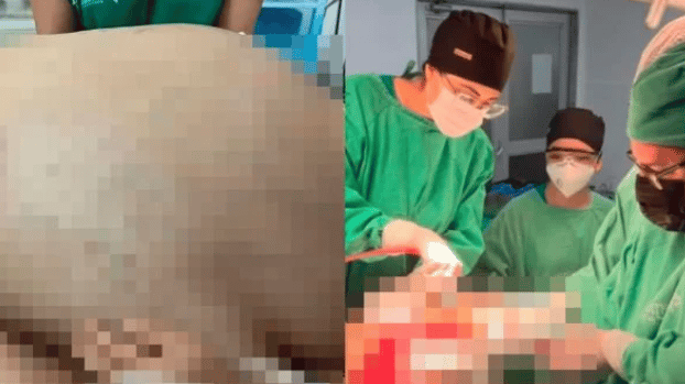 Médicos retiram tumor de 46 quilos de paciente em cirurgia de emergência