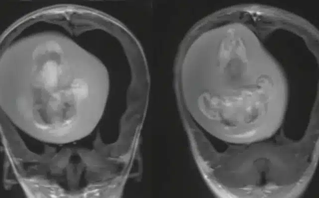 Menina de 1 ano passa por cirurgia para retirar do cérebro feto do irmão gêmeo