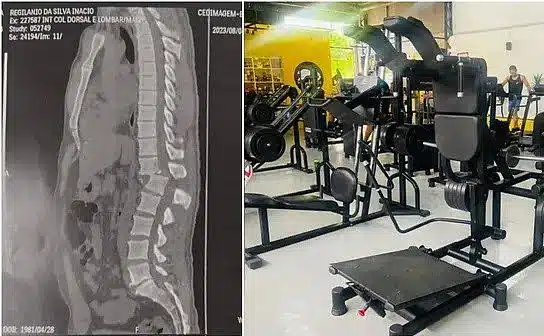 Homem atingido por aparelho na academia pode ficar paraplégico; veja raio-x