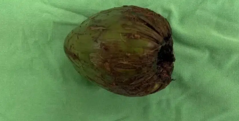 Homem é operado após inserir coco no corpo para estimulação sexual