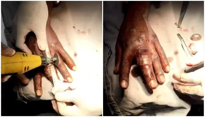 Homem prende anel no dedo e precisa de anestesia para tirar no HGE