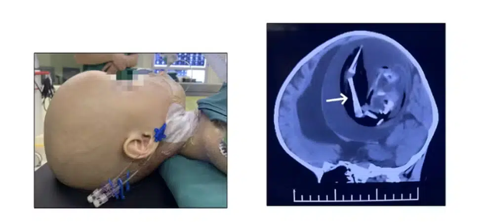 ‘Feto parasita’ é encontrado dentro da cabeça de bebê